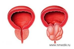 Растения для лечения заболеваний предстательной железы